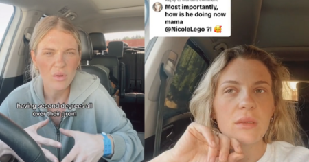 second-degree burns from Cup Noodles